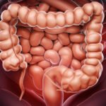 colon cancer