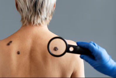 skin cancer